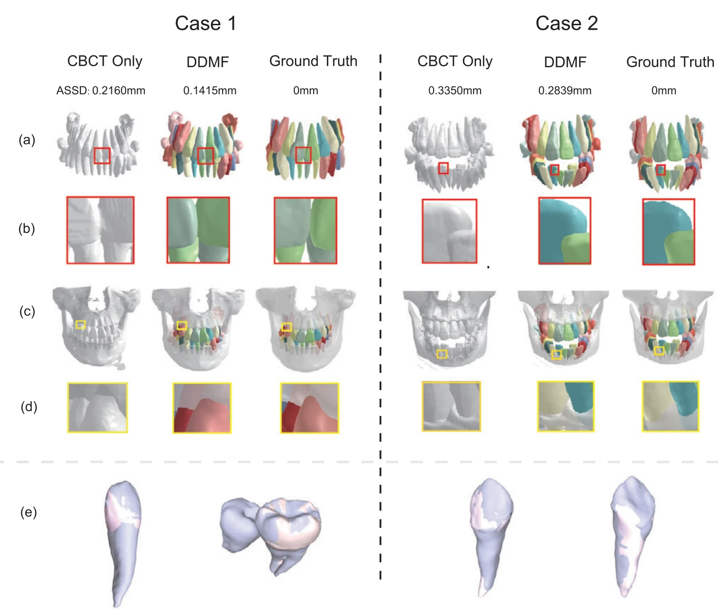 两个病例,每例三列:仅用 CBCT(灰色)、DDMF 和金标准(不同牙齿以不同颜色显示)。各行依次为重建的牙列、放大的牙齿边界、带牙槽骨的牙列、放大的牙–骨区域和单颗牙。每列上方标有 ASSD 数值。